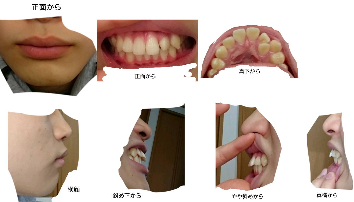 写真あり 出っ歯の歯列矯正 顎変形症の保険適用について 歯チャンネル歯科相談室