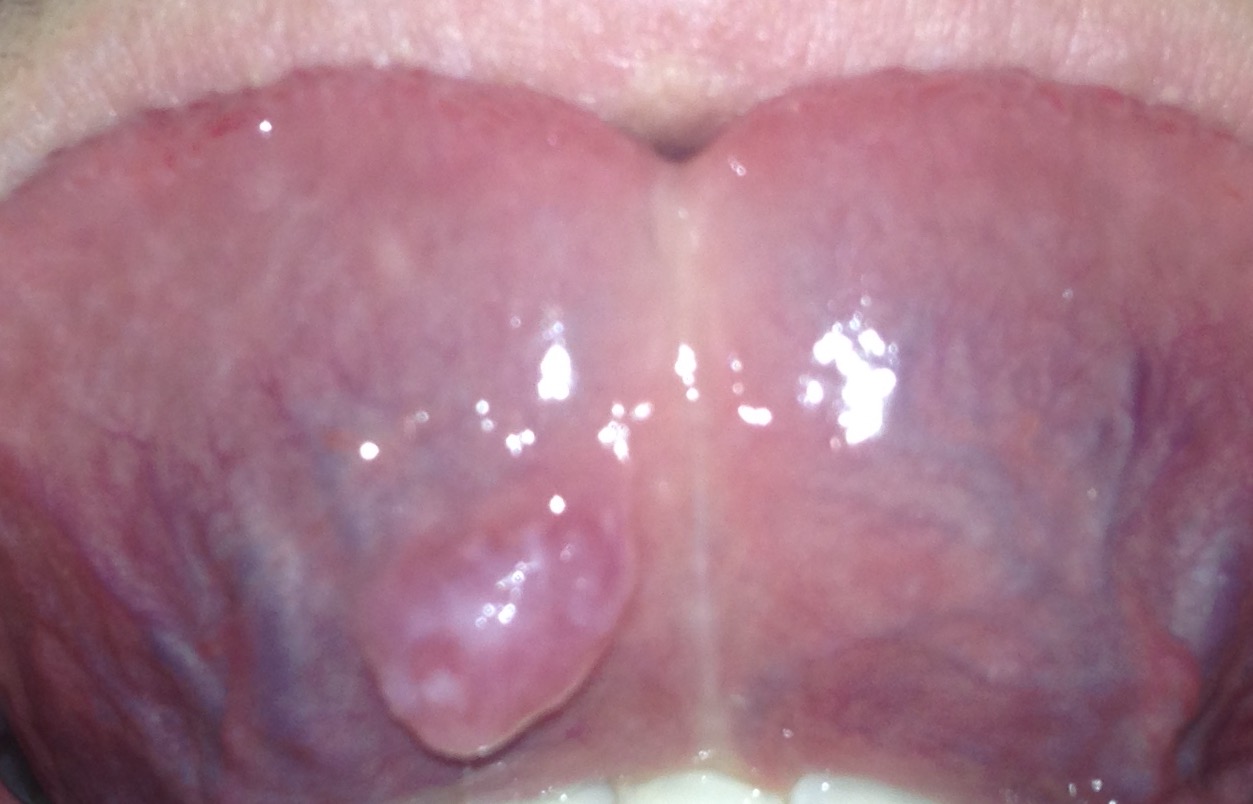 写真あり 二ヶ月ほど舌の裏側の口内炎が治らない 舌癌か 歯チャンネル歯科相談室