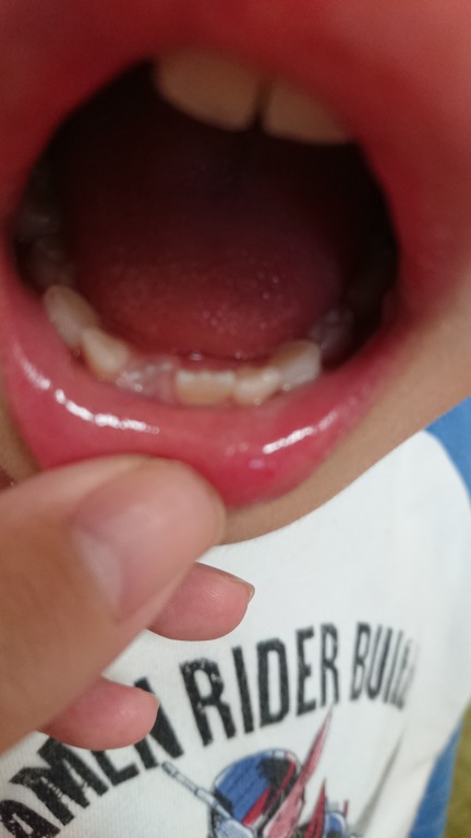写真あり 下前歯の永久歯が斜めに生えてきた 歯チャンネル歯科相談室