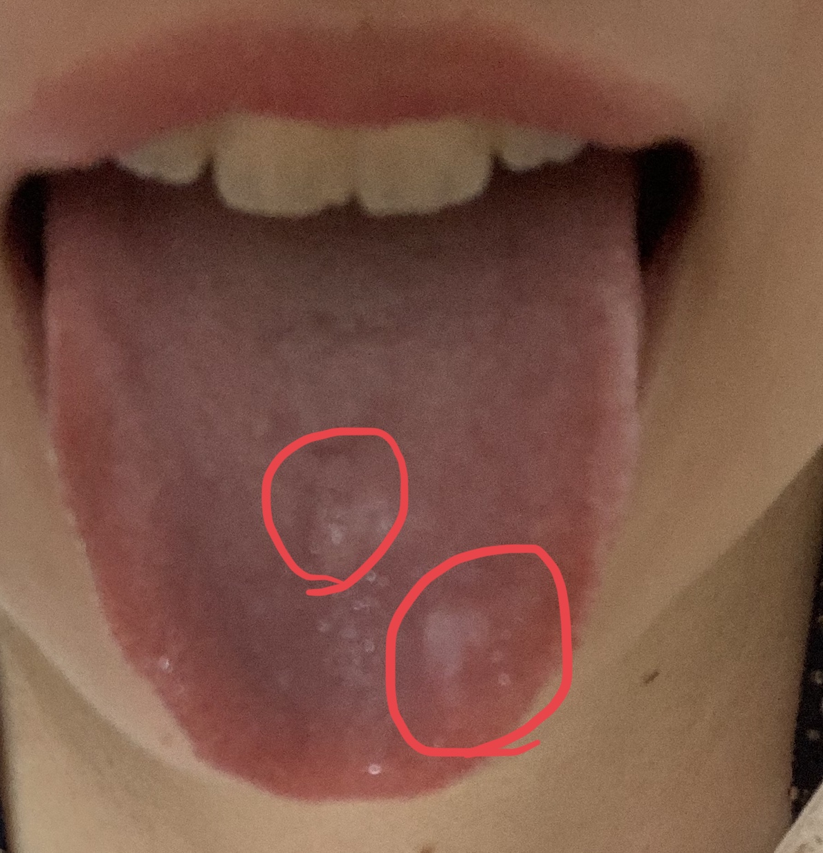 写真あり 舌の表面に白い斑点と内頬に赤く丸い出来物 歯チャンネル歯科相談室