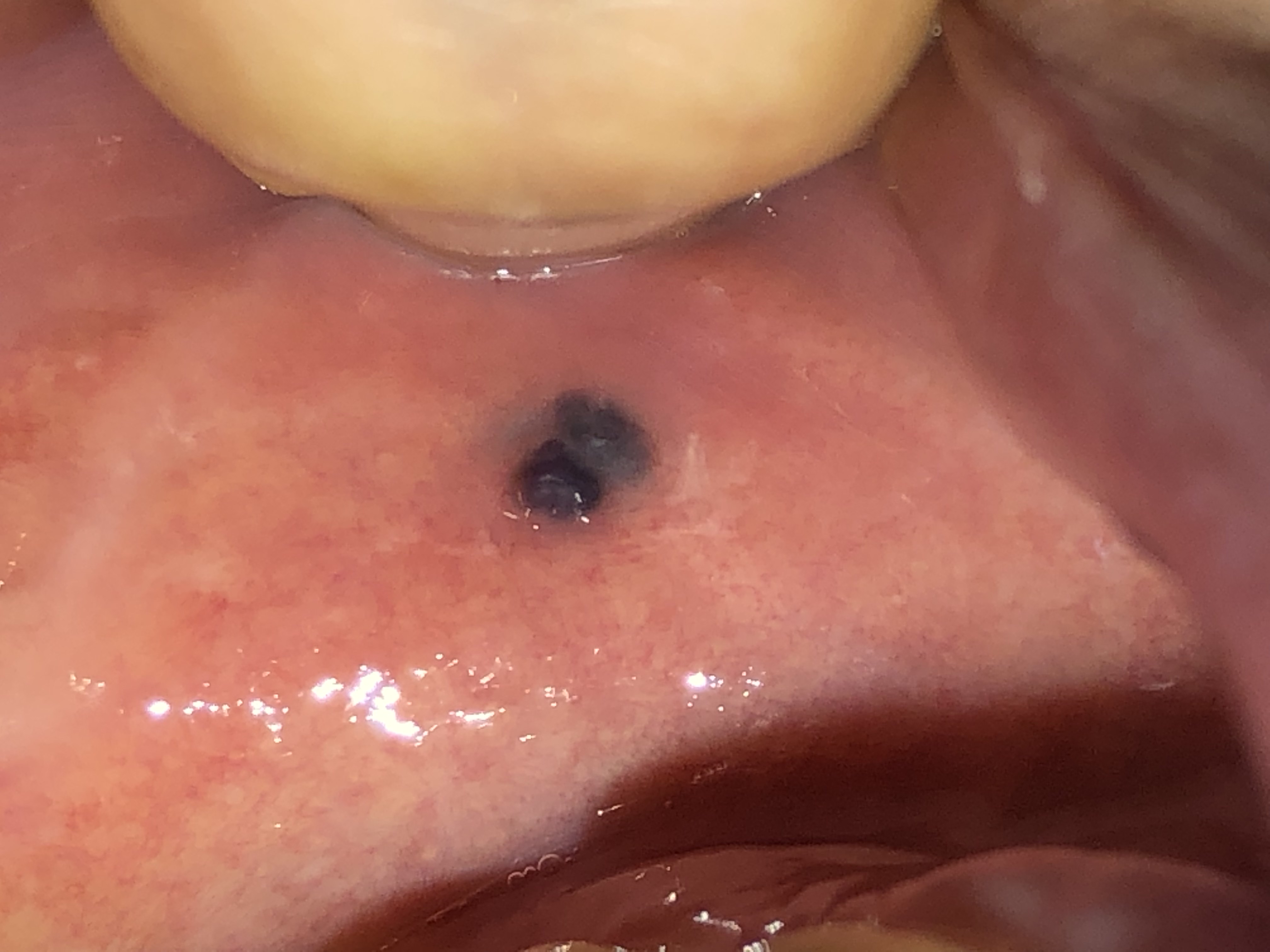 左頬粘膜にできた黒い血豆らしきものが膨らんできている 歯チャンネル歯科相談室