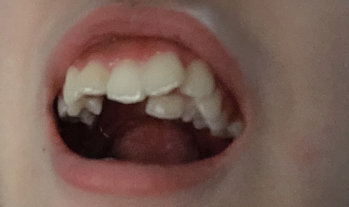 写真あり 二重歯列の抜歯と矯正について 歯チャンネル歯科相談室