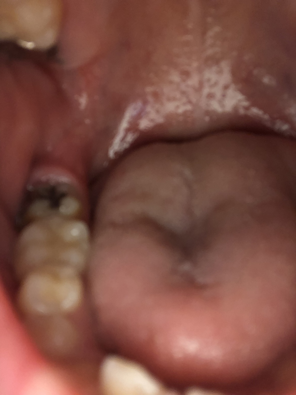 が 奥 の 腫れる 歯茎 奥歯の歯茎が腫れる3つの原因と応急処置