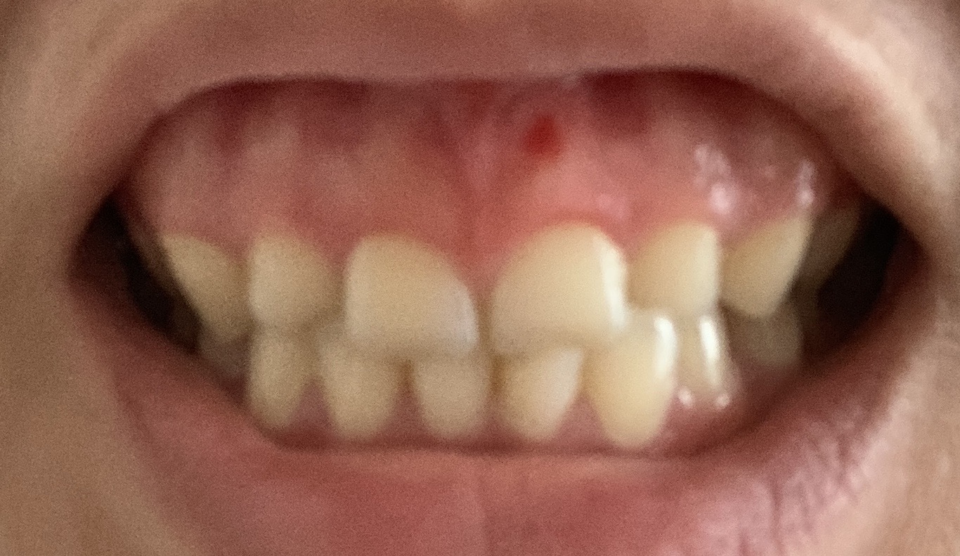 [写真あり] 唇上部をぶつけ歯茎から出血、受診の緊急性は？ 歯チャンネル歯科相談室
