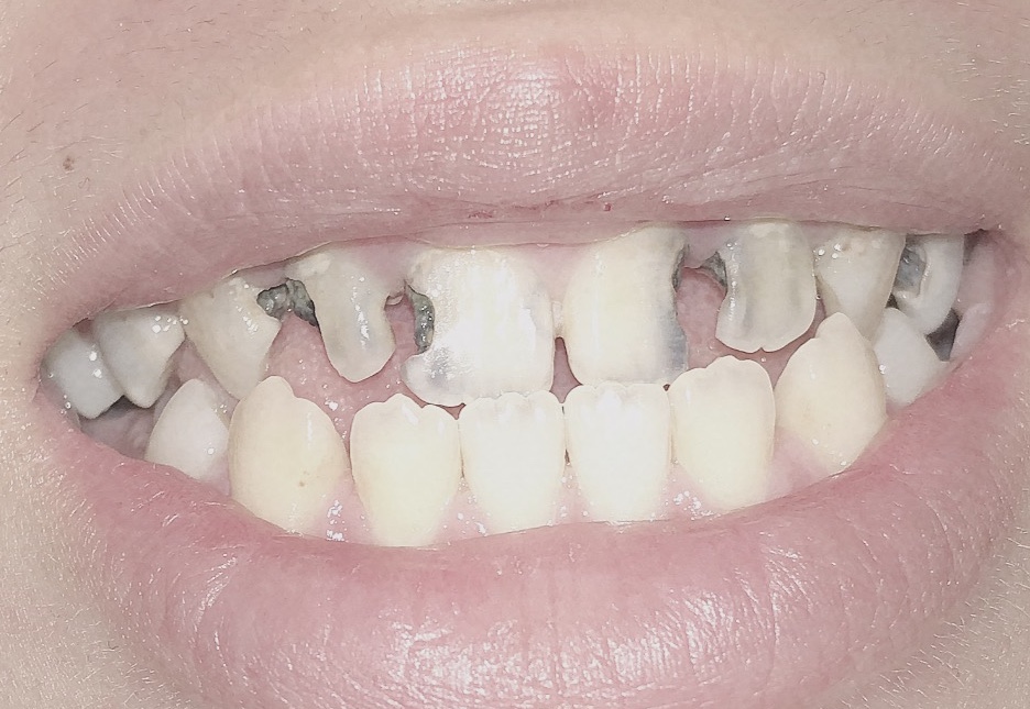 写真あり 放置した前歯の虫歯をレジンで治せますか 治療費は 歯チャンネル歯科相談室