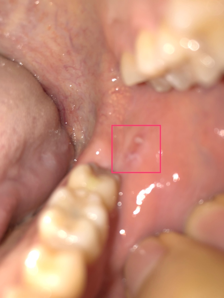 写真あり 左頬の内側に白い出来物が２つあり不安 歯チャンネル歯科相談室