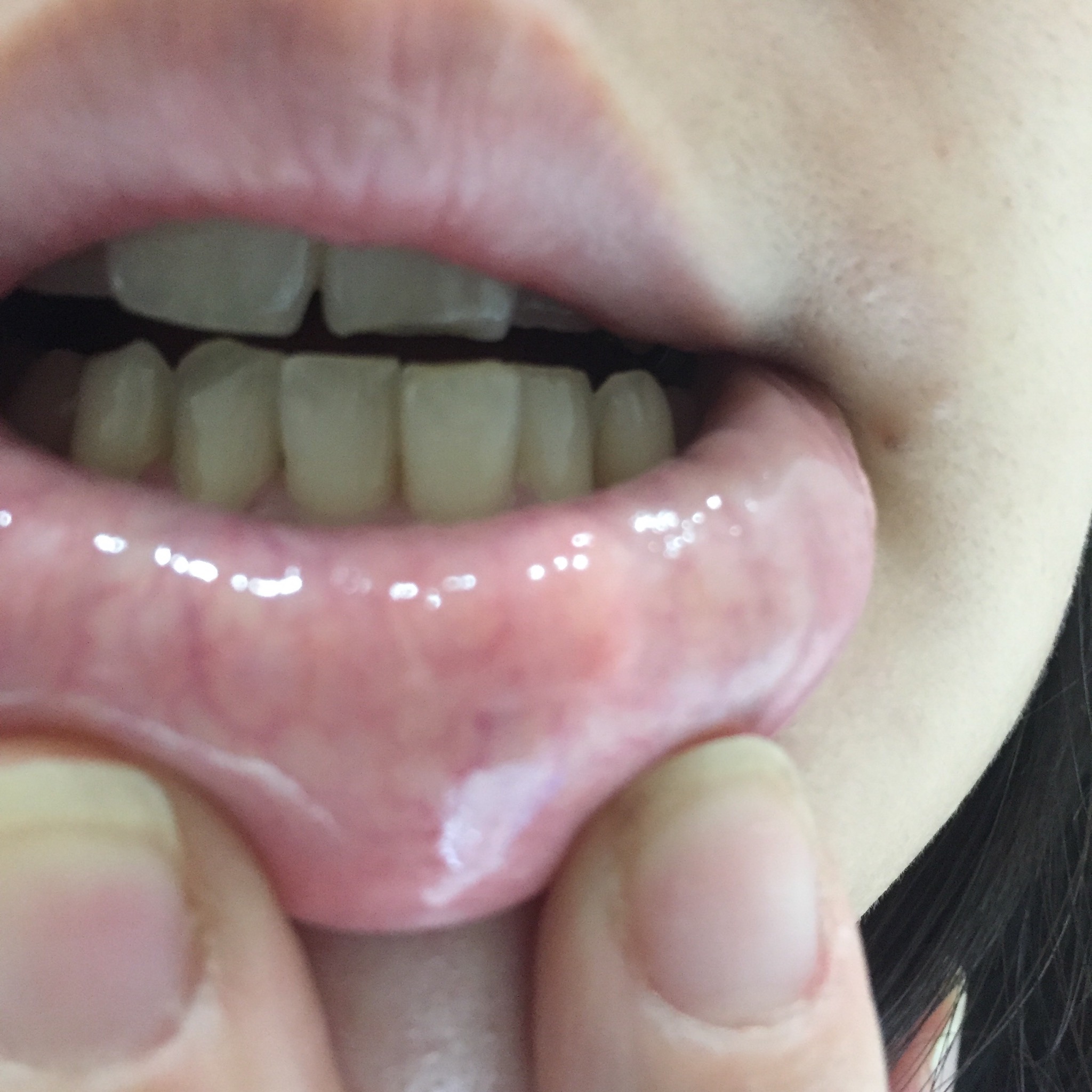 [写真あり] 下唇の裏の白い横線と、その中の膨らみが気になります 歯チャンネル歯科相談室