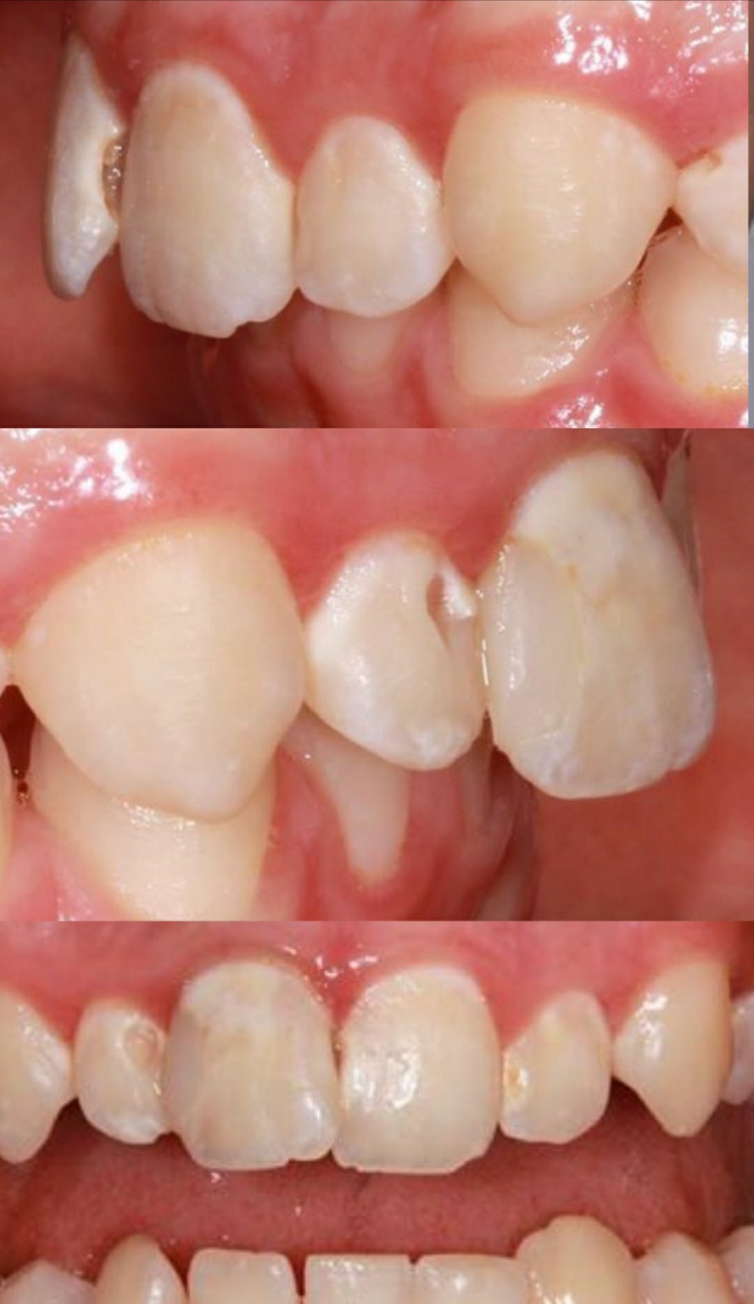 写真あり １１歳児 前歯にいくつか穴が どのくらいの進行度ですか 歯チャンネル歯科相談室