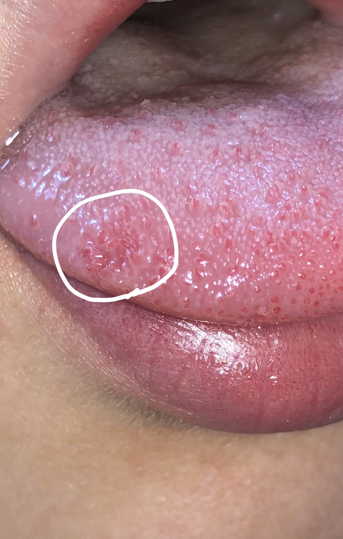 痛い 舌 舌の裏のひだが痛い時に考えられる原因と対策について解説
