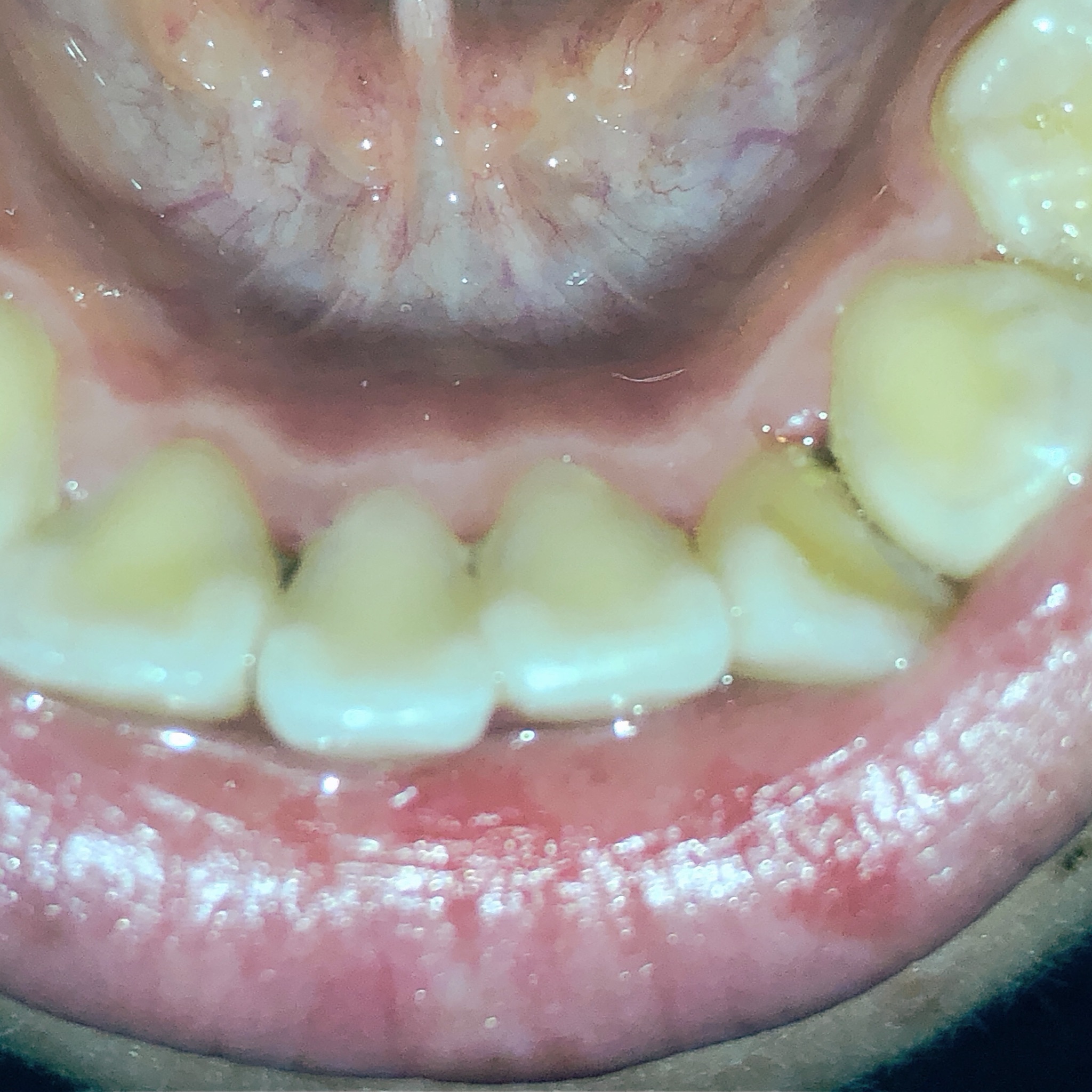 写真あり 歯の裏に黒いものがあり冷痛も どの程度進行しているか 歯チャンネル歯科相談室