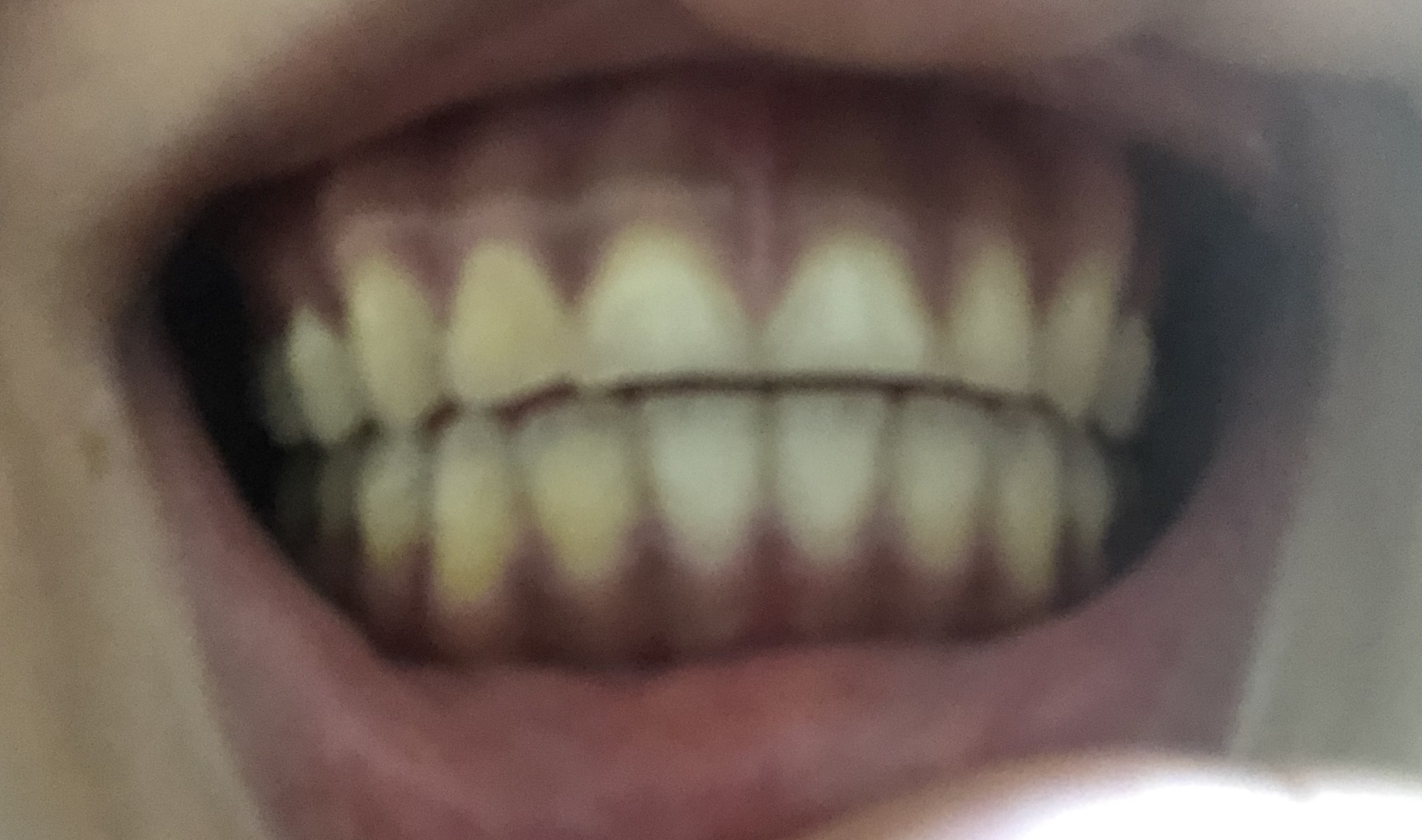 写真あり 過食嘔吐と食いしばり 摩耗した前歯の治療について 歯チャンネル歯科相談室