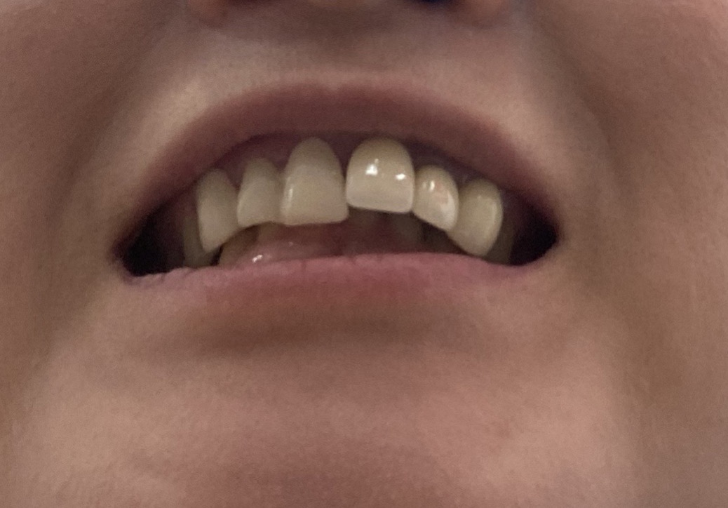 [写真あり] 根管治療後、上顎の差し歯と下の歯に隙間がある 歯チャンネル歯科相談室