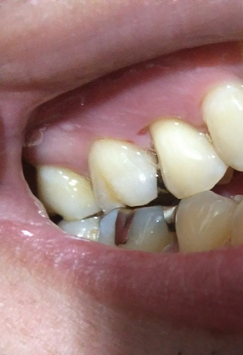 [写真あり] 1ヶ月前に麻酔を打った歯茎が腫れて出血し穴が開いている 歯チャンネル歯科相談室