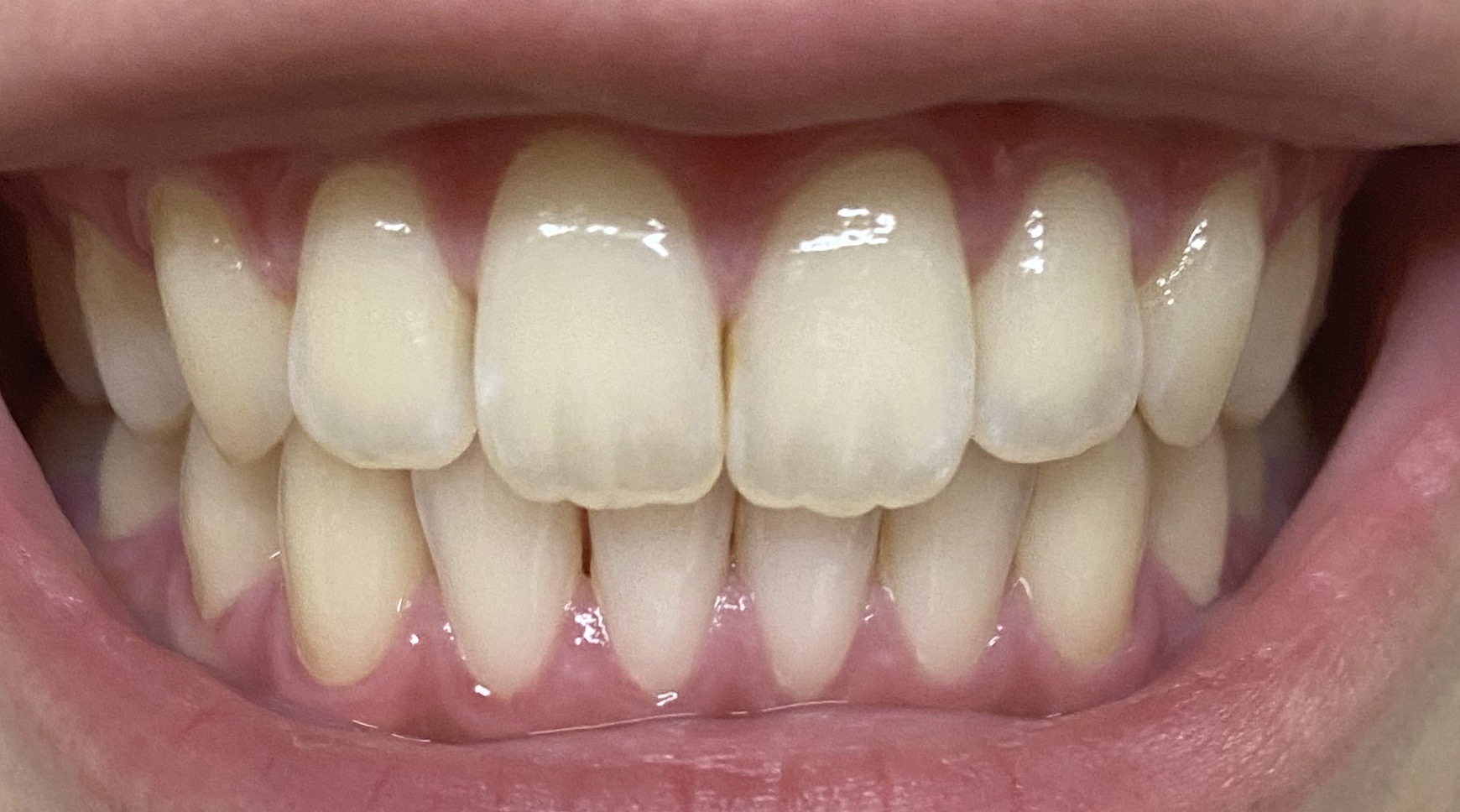 [写真あり] 歯の先端が透明、酸蝕歯でホワイトニングは出来ますか？
