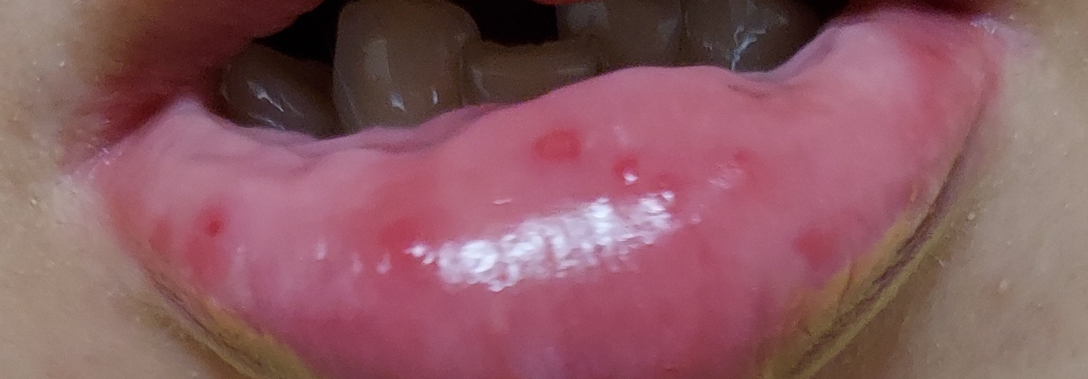 写真あり 唇の裏に複数の赤い斑点 歯チャンネル歯科相談室